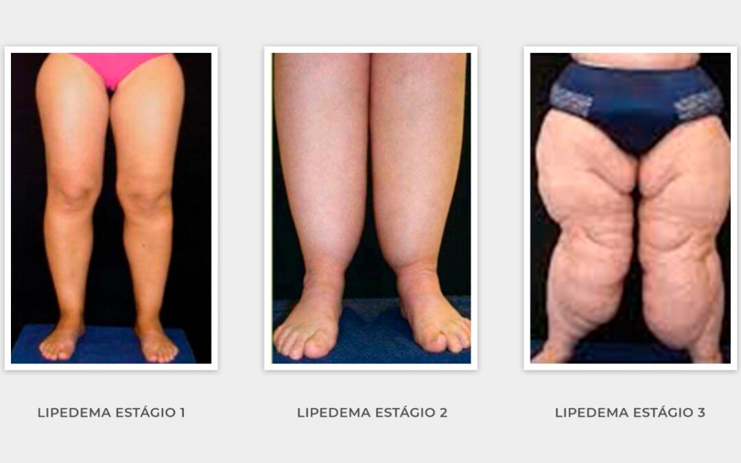 Protegido: Lipedema